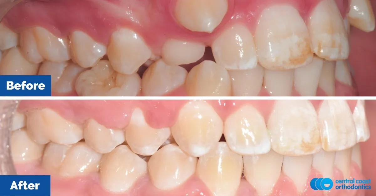 Before and after comparison, side view of the upper and lower teeth