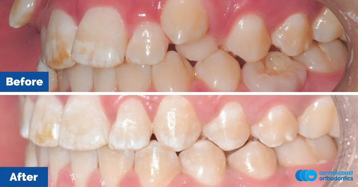 Before and after comparison, side view of the upper and lower teeth