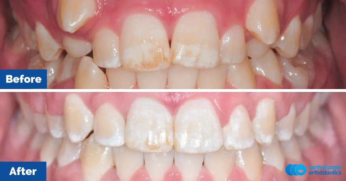 Before and after comparison, front view of the upper and lower teeth