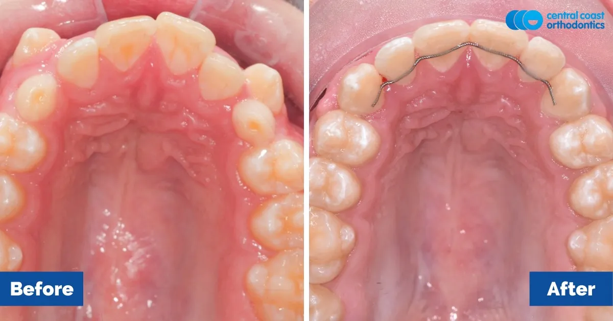 Before and after comparison, upper teeth viewed from below
