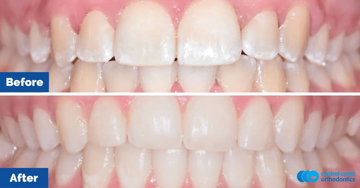 Before and after comparison, front view of the upper and lower teeth