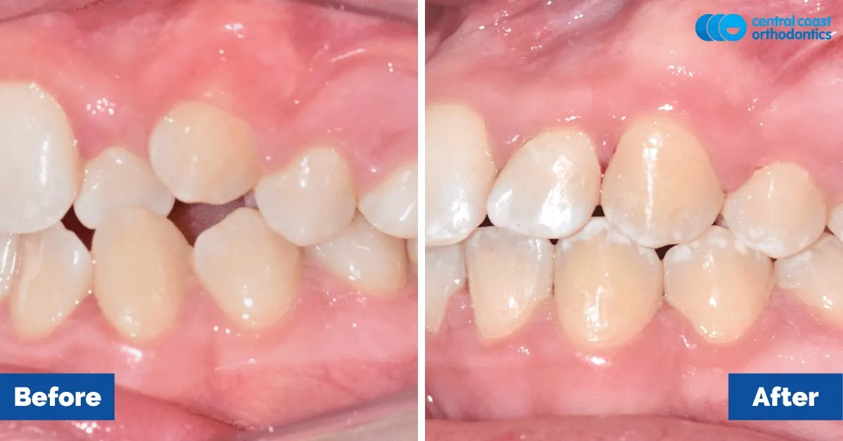 Before and after comparison, side view of the upper and lower teeth