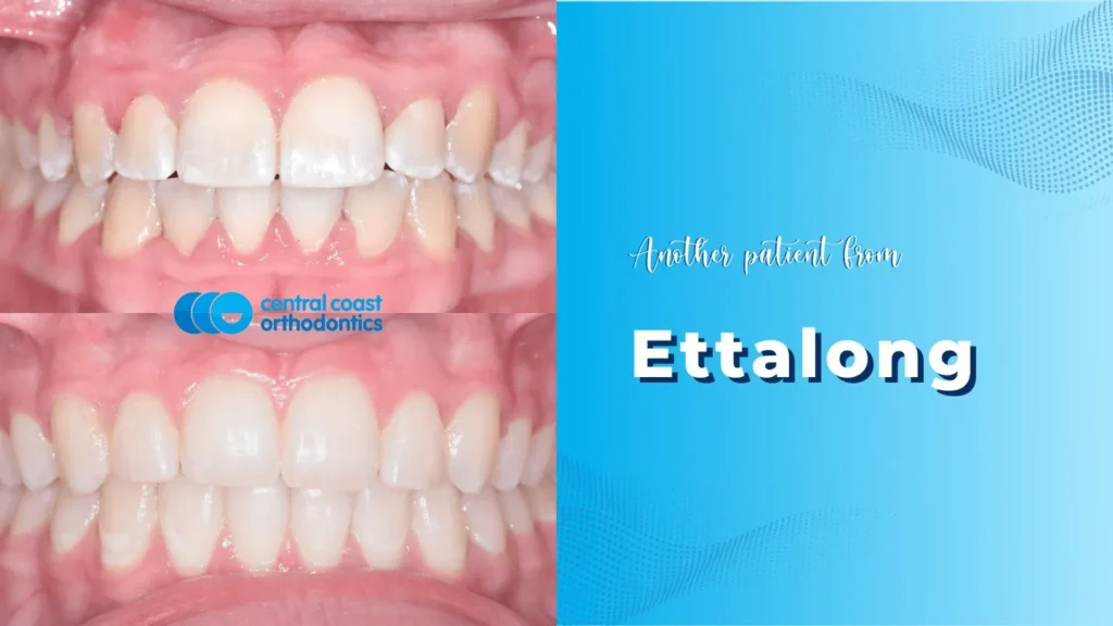 Before and after photographs of a Central Coast Orthodontics patient's teeth, labelled Ettalong