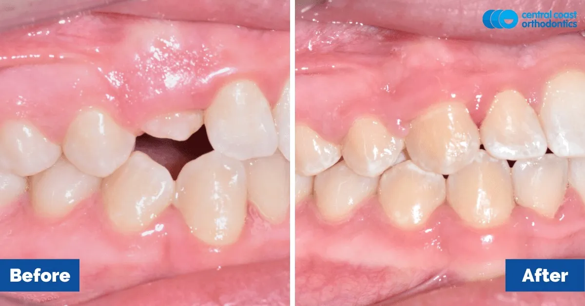 Before and after comparison, side view of the upper and lower teeth