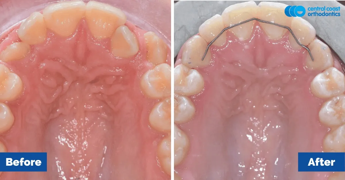 Before and after comparison, upper teeth viewed from below