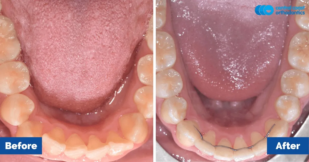 Before and after comparison, lower teeth viewed from above