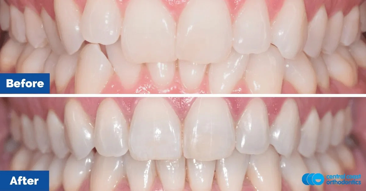 Before and after comparison, front view of the upper and lower teeth