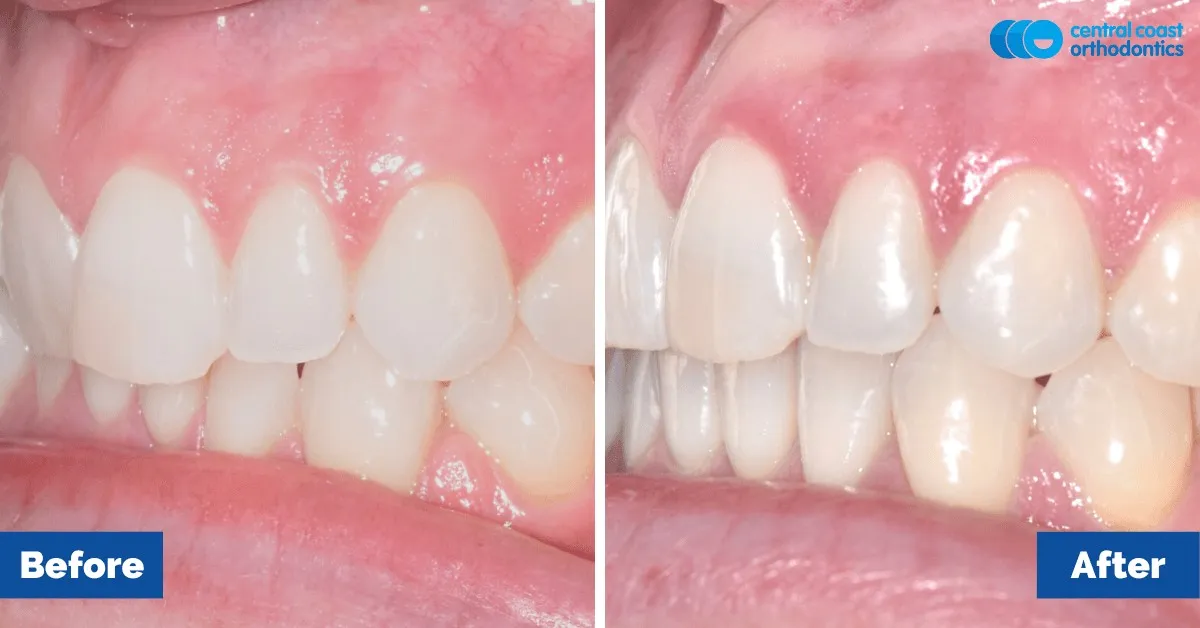Before and after comparison, side view of the upper and lower teeth