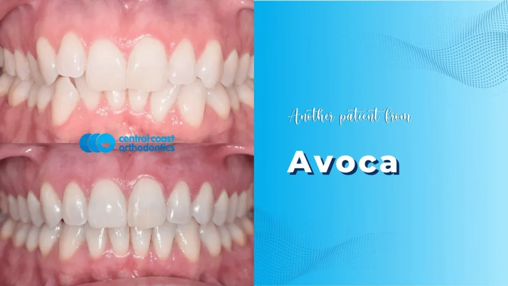 Before and after photographs of a Central Coast Orthodontics patient's teeth, labelled Avoca
