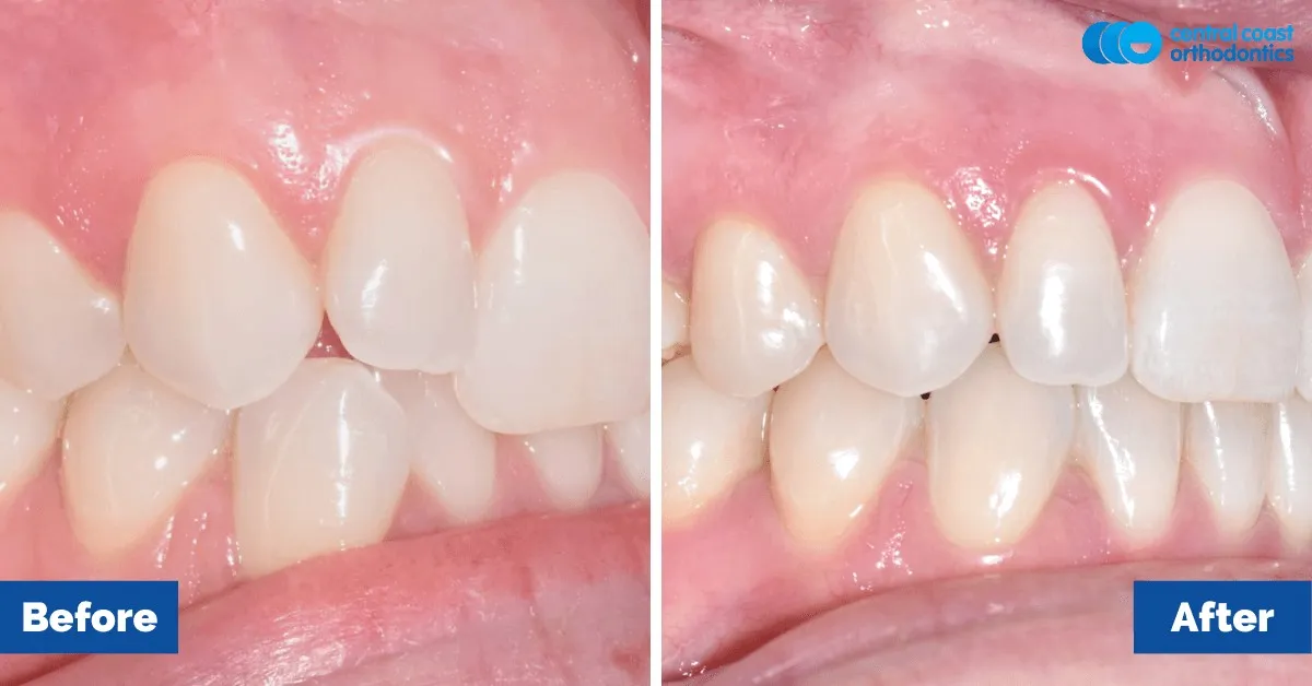 Before and after comparison, side view of the upper and lower teeth