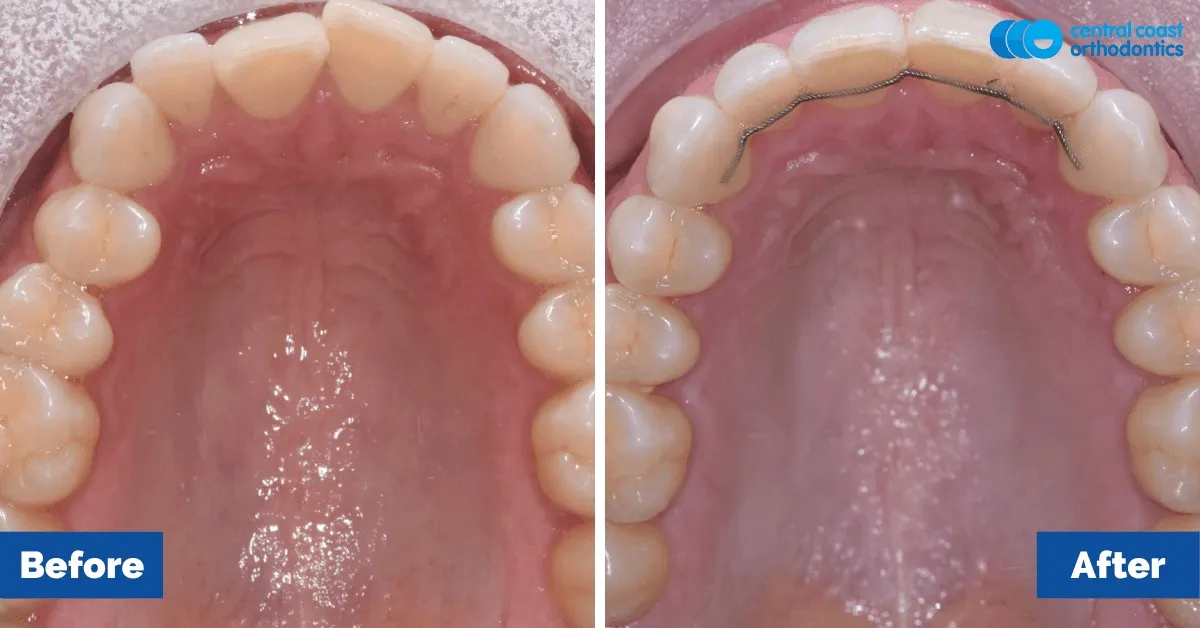 Before and after comparison, upper teeth viewed from below