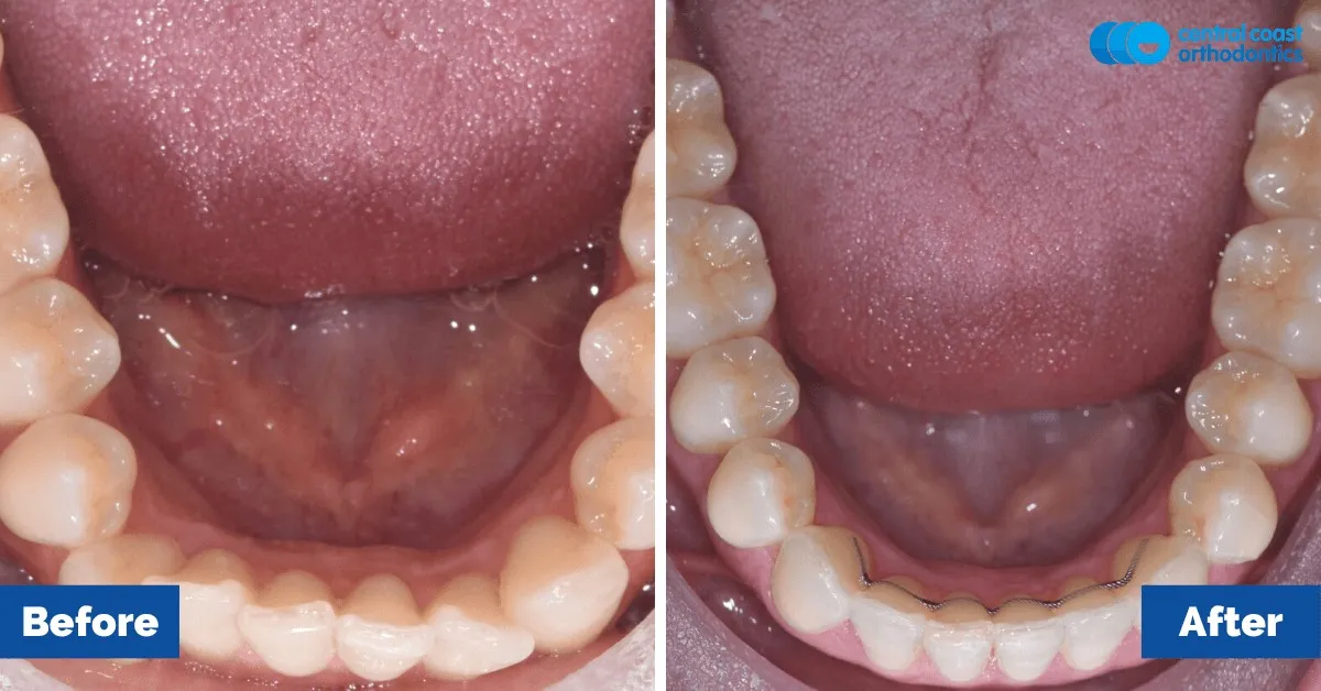Before and after comparison, lower teeth viewed from above