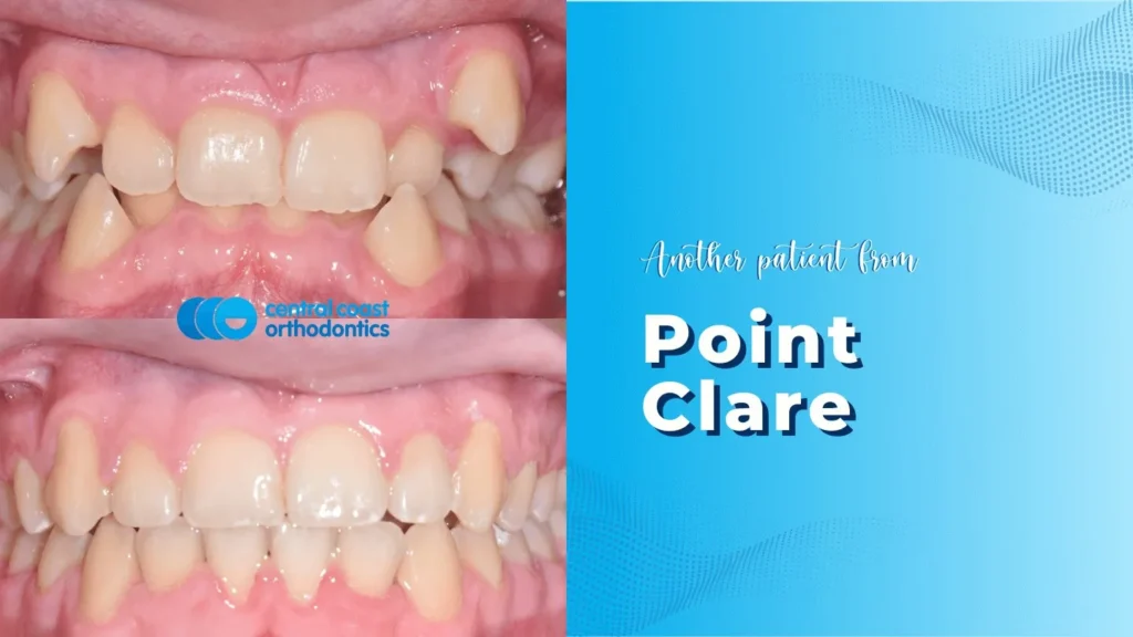 Before and after photographs of a Central Coast Orthodontics patient's teeth, labelled Point Clare