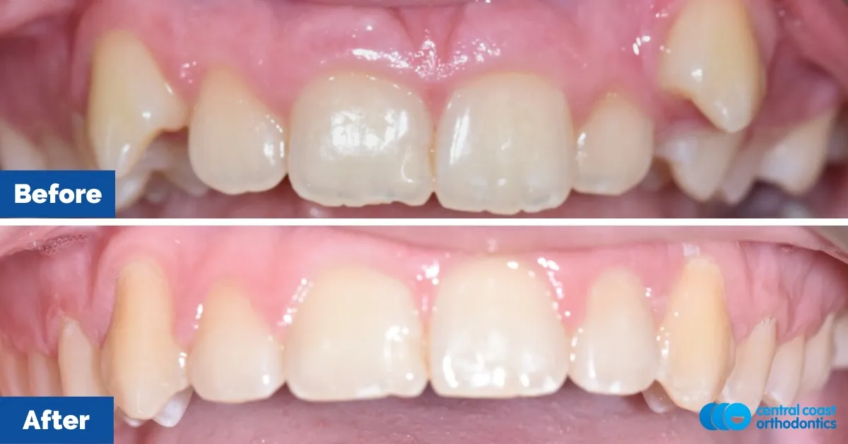 Before and after comparison, front view of the upper and lower teeth