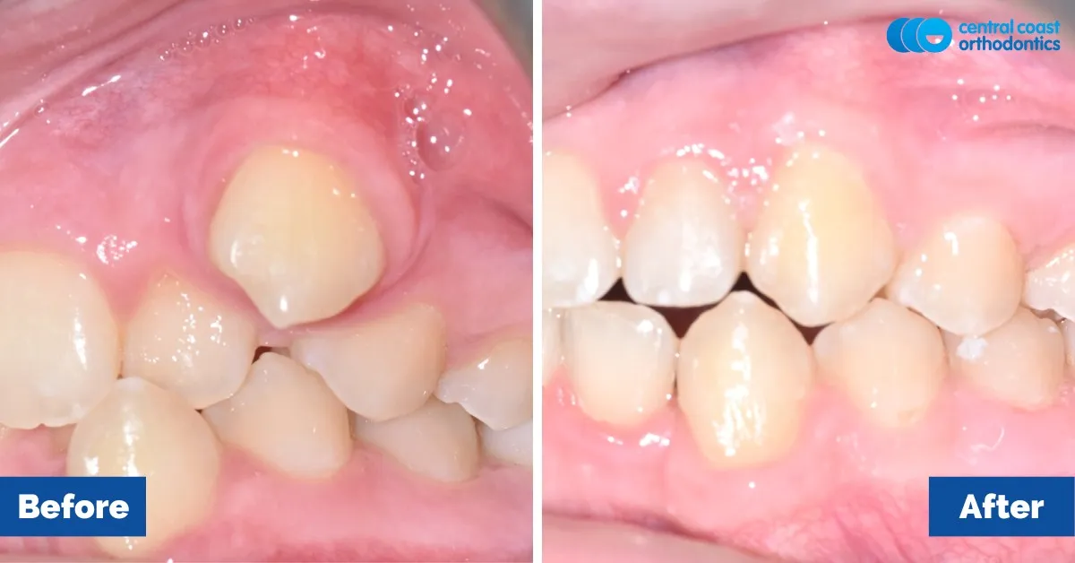 Before and after comparison, side view of the upper and lower teeth