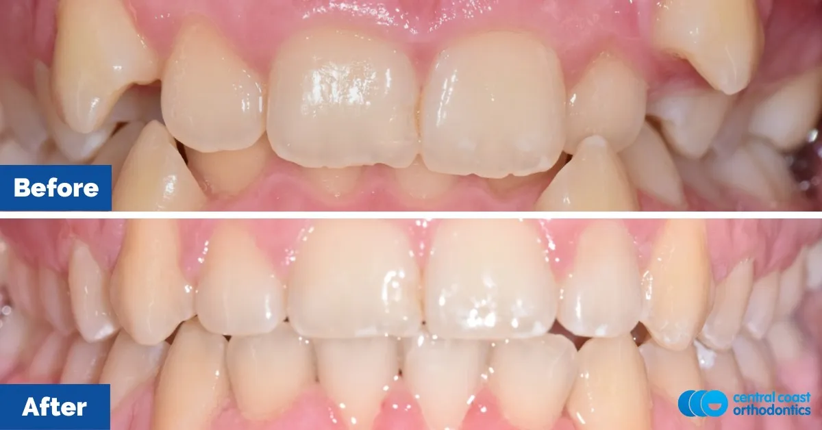 Before and after comparison, side view of the upper and lower teeth