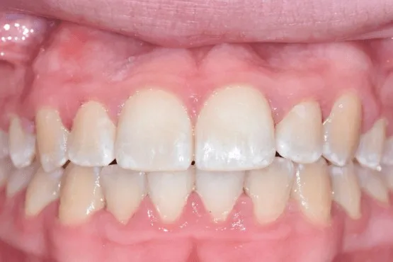 Close-up of upper front teeth overlapping the lower teeth with an uneven bite, before orthodontic treatment