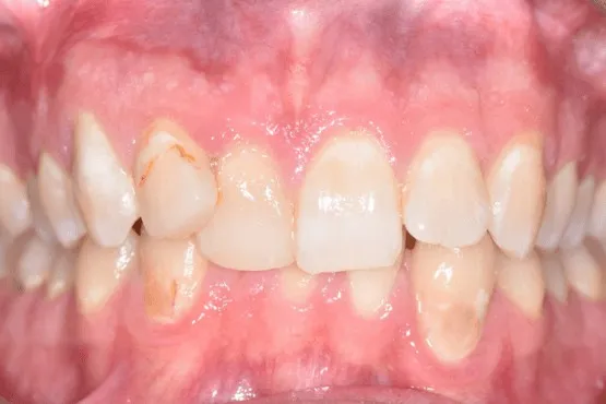 Close-up of crowded and rotated front teeth with surface staining before orthodontic treatment