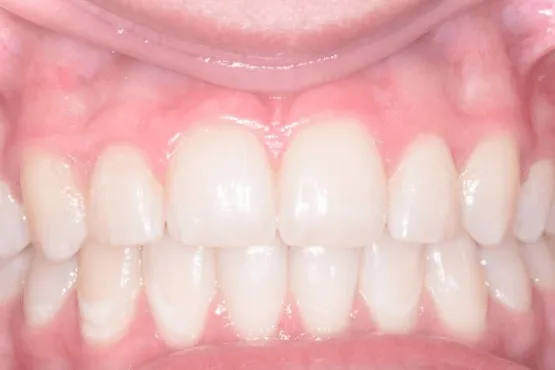 The same patient's upper and lower front teeth evenly aligned after orthodontic treatment