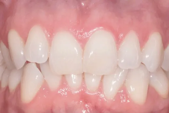Close-up of front teeth with uneven spacing and gaps before orthodontic treatment