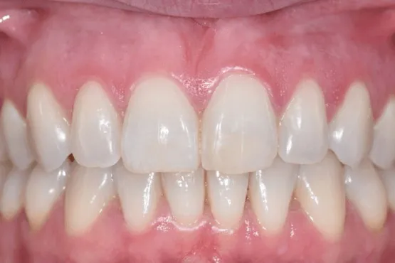 The same patient's front teeth closed up and aligned after orthodontic treatment