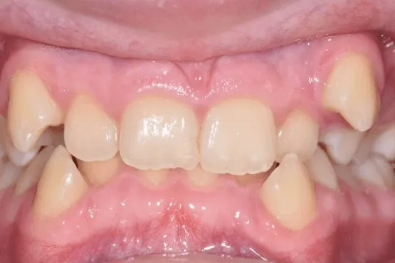 Close-up of upper canines sitting high and outside the dental arch with crowded front teeth, before orthodontic treatment