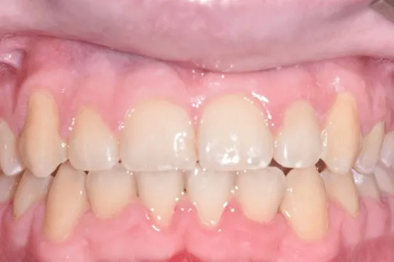 The same patient's canines brought into the arch and front teeth aligned after orthodontic treatment