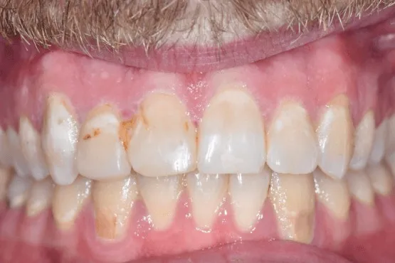 The same patient's front teeth aligned after orthodontic treatment
