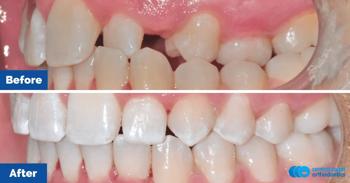 Before and after comparison, side view of the upper and lower teeth