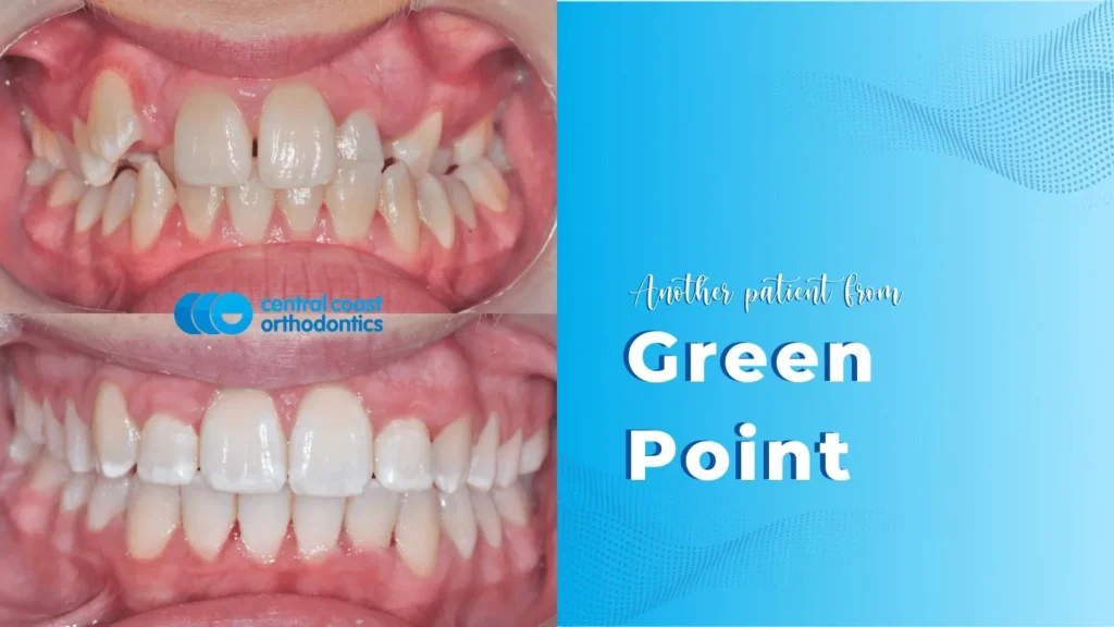 Before and after photographs of a Central Coast Orthodontics patient's teeth, labelled Green Point