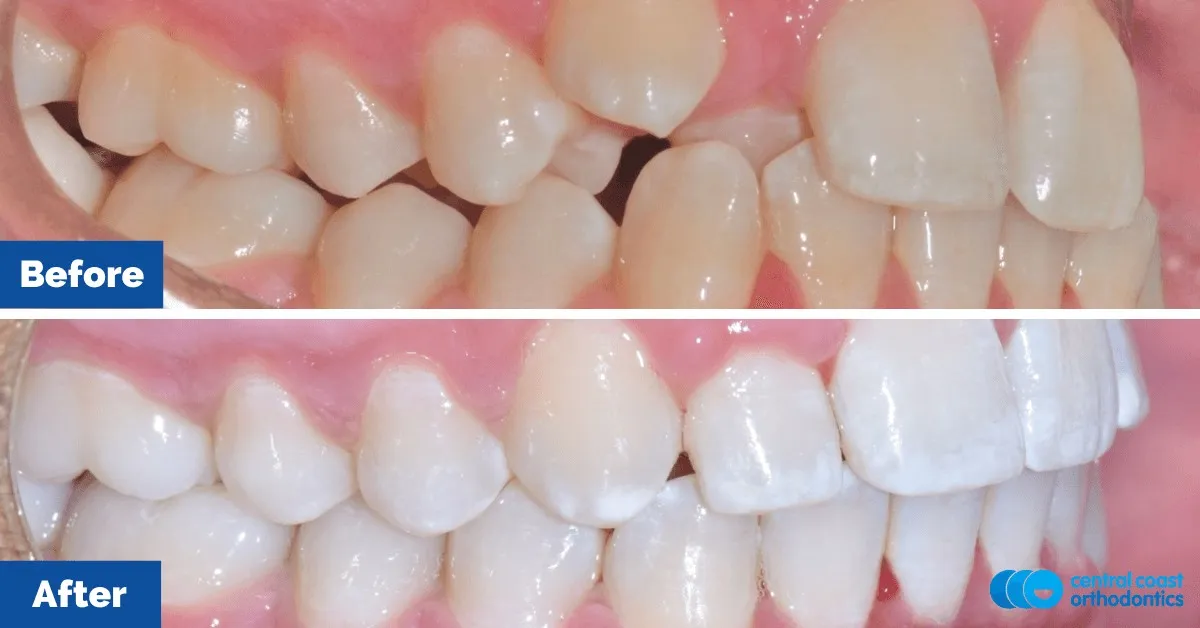 Before and after comparison, side view of the upper and lower teeth