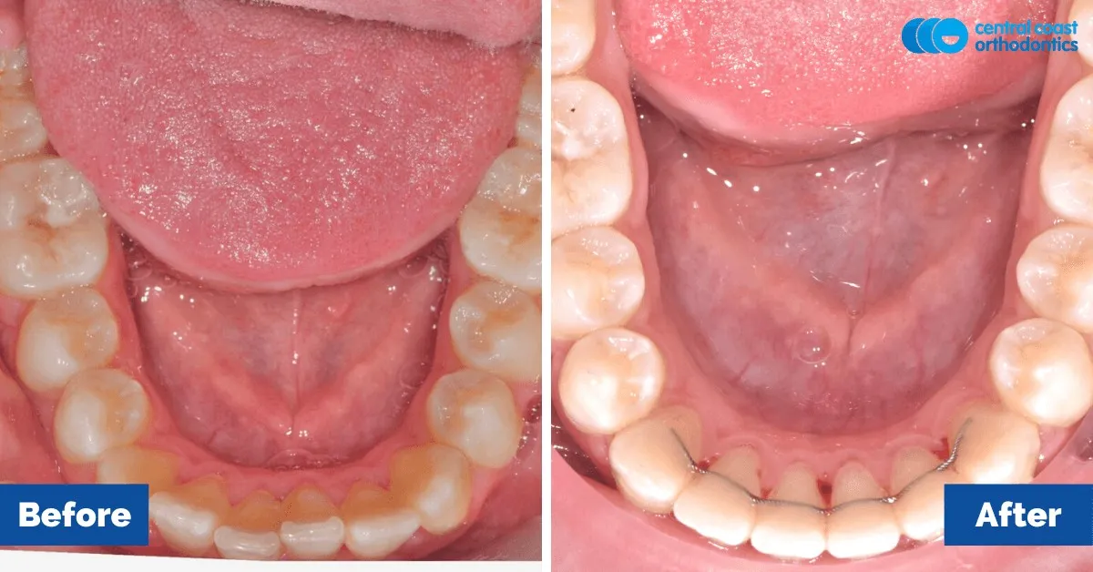 Before and after comparison, lower teeth viewed from above
