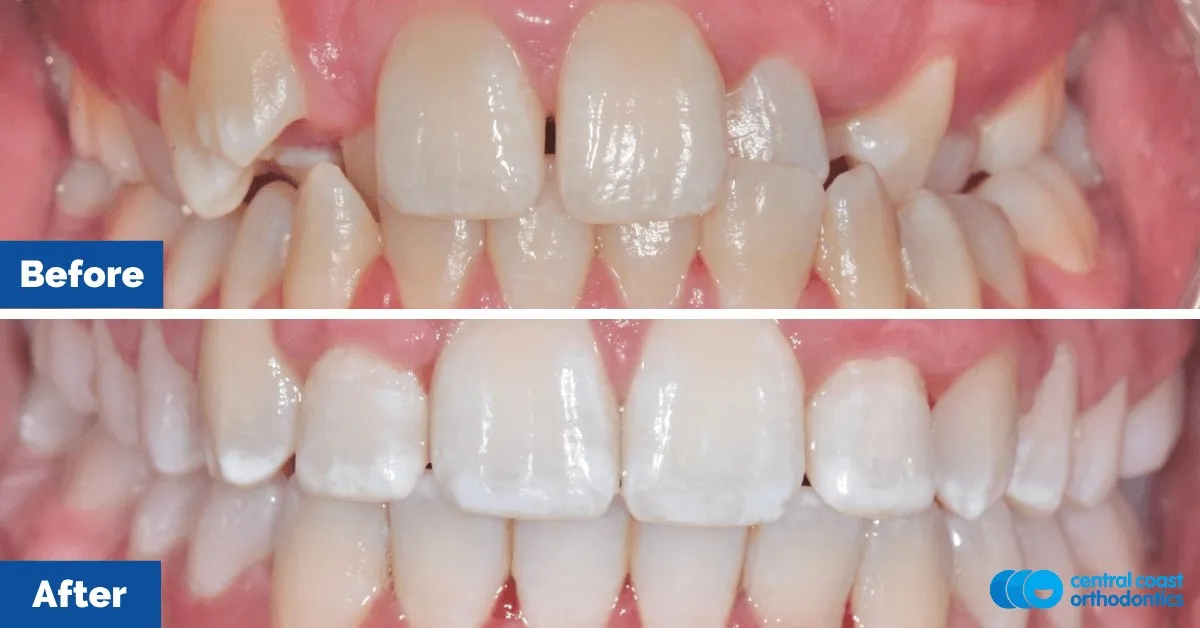 Before and after comparison, front view of the upper and lower teeth