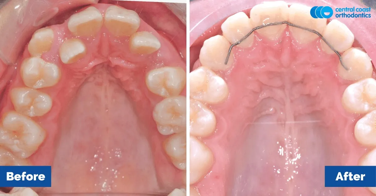 Before and after comparison, upper teeth viewed from below