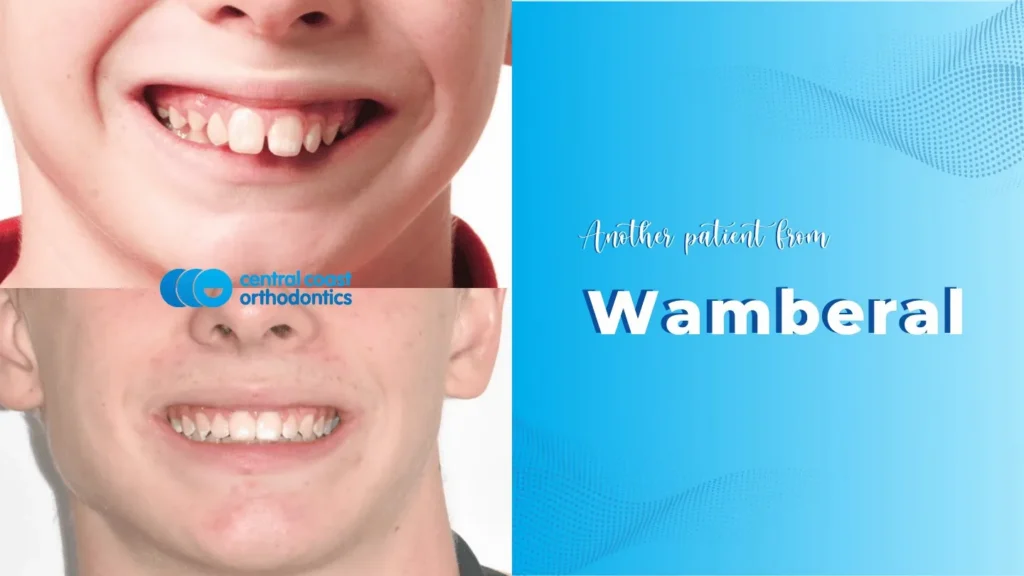 Before and after photographs of a Central Coast Orthodontics patient's smile, labelled Wamberal
