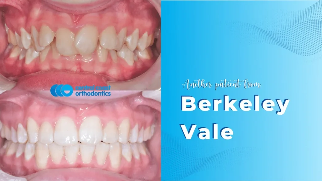 Before and after photographs of a Central Coast Orthodontics patient's teeth, labelled Berkeley Vale