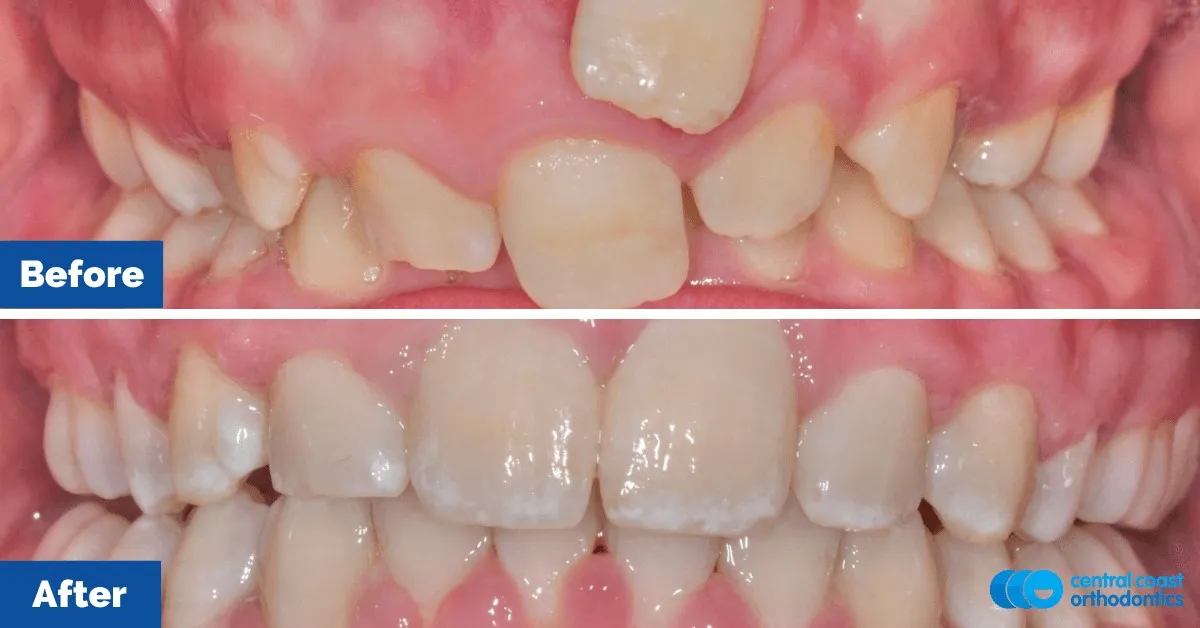 Before and after comparison, front view of the upper and lower teeth