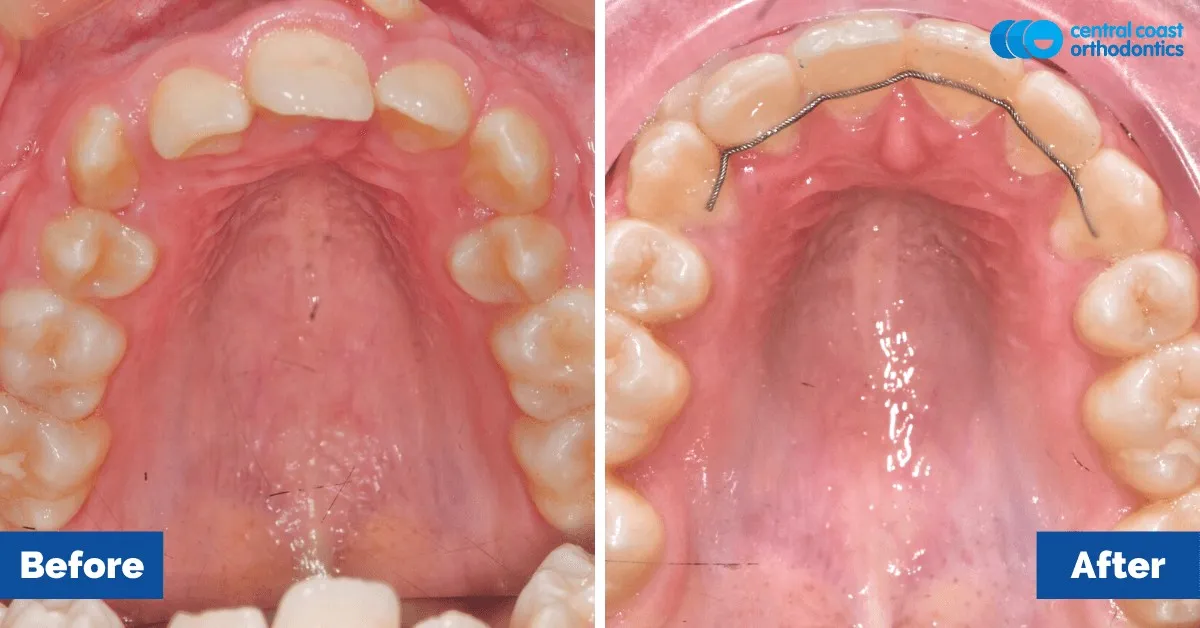 Before and after comparison, upper teeth viewed from below