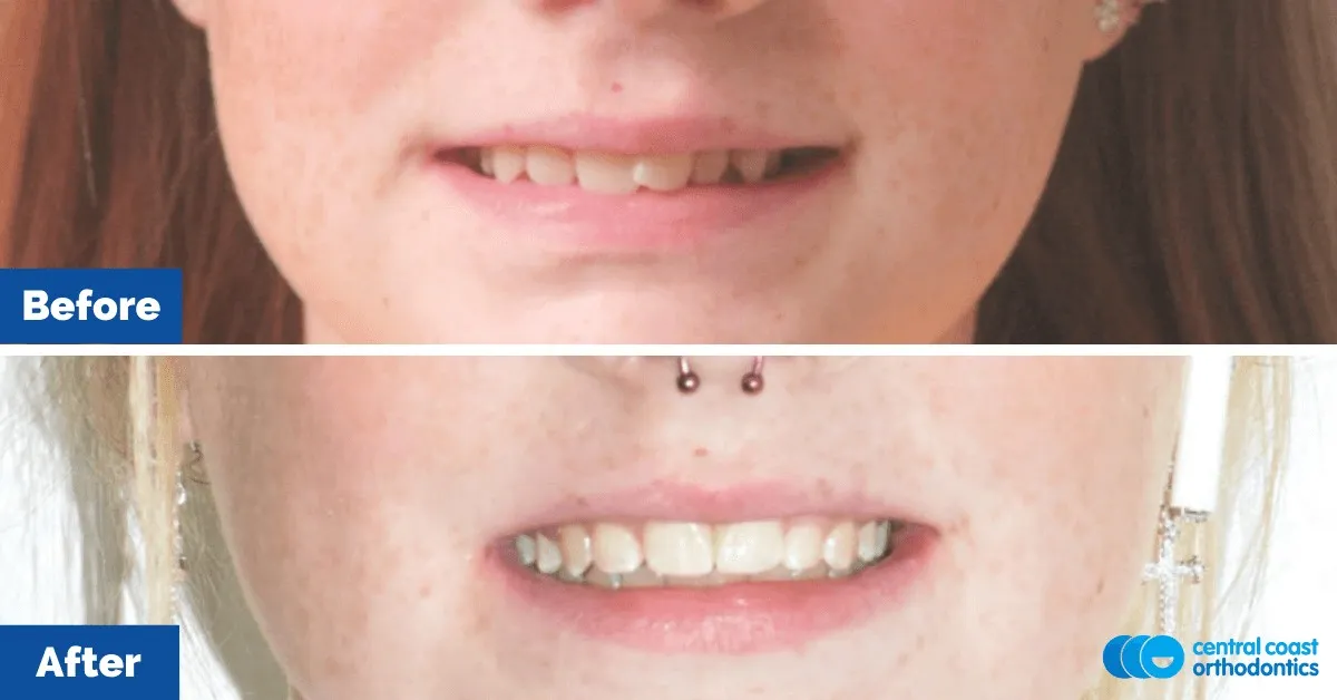 Before and after comparison of the patient's smile