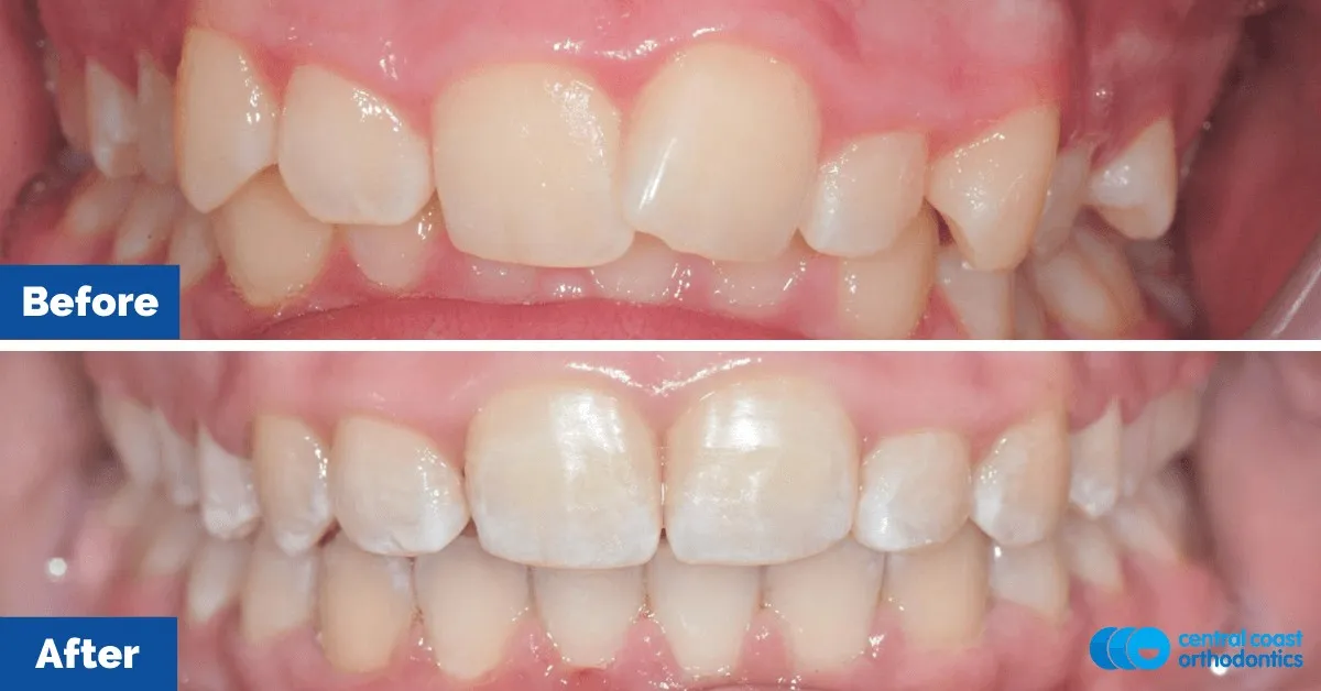Before and after comparison, front view of the upper and lower teeth