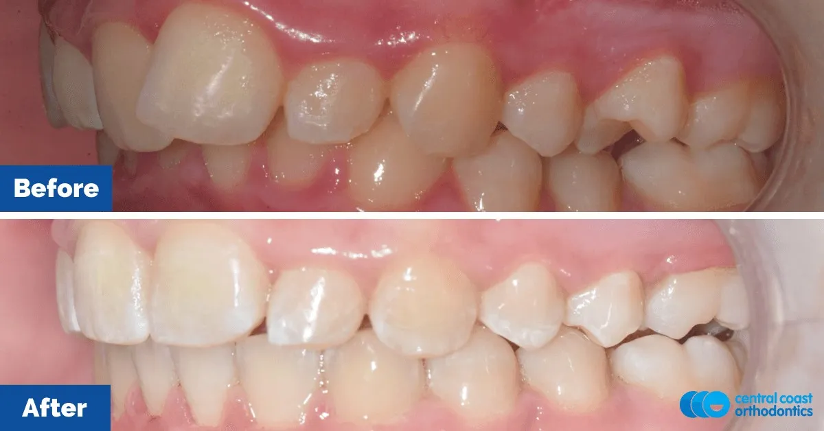 Before and after comparison, side view of the upper and lower teeth
