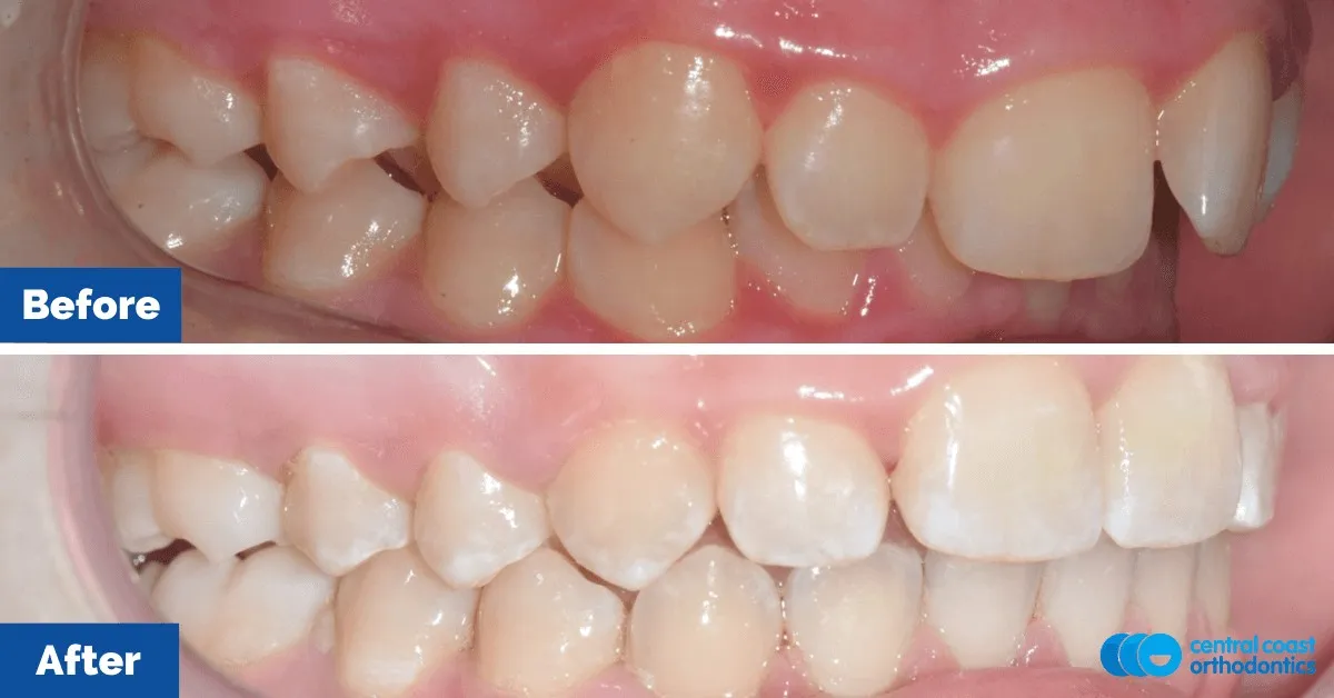 Before and after comparison, side view of the upper and lower teeth