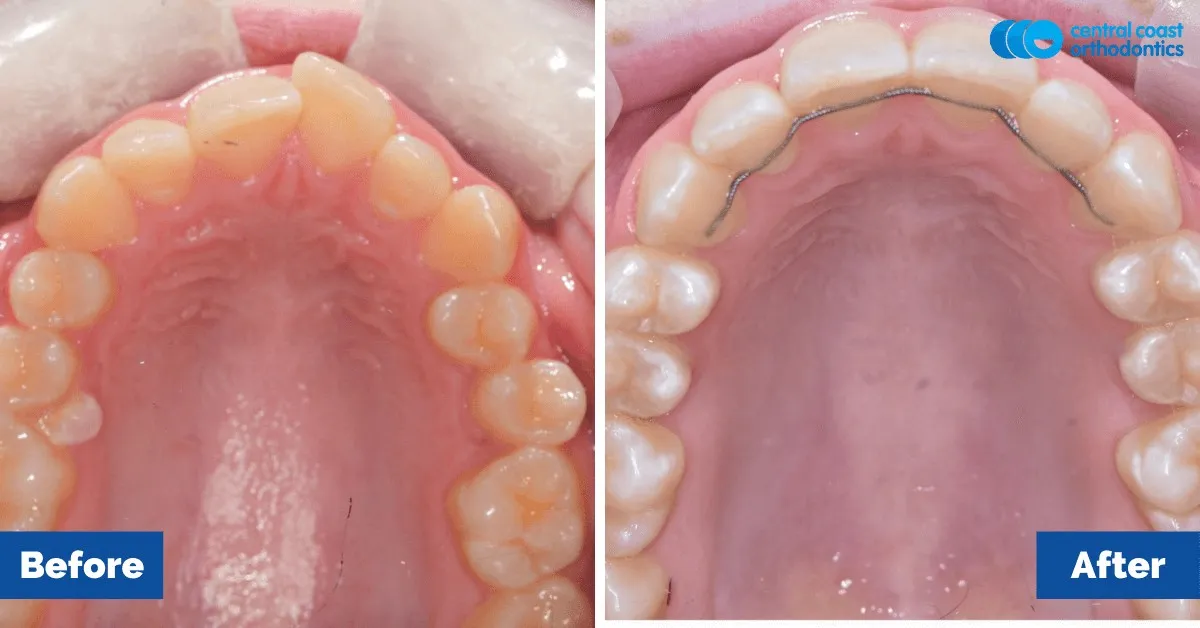 Before and after comparison, upper teeth viewed from below