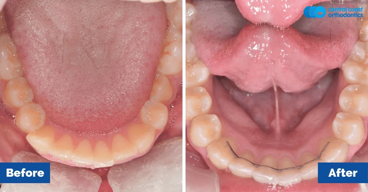Before and after comparison, lower teeth viewed from above