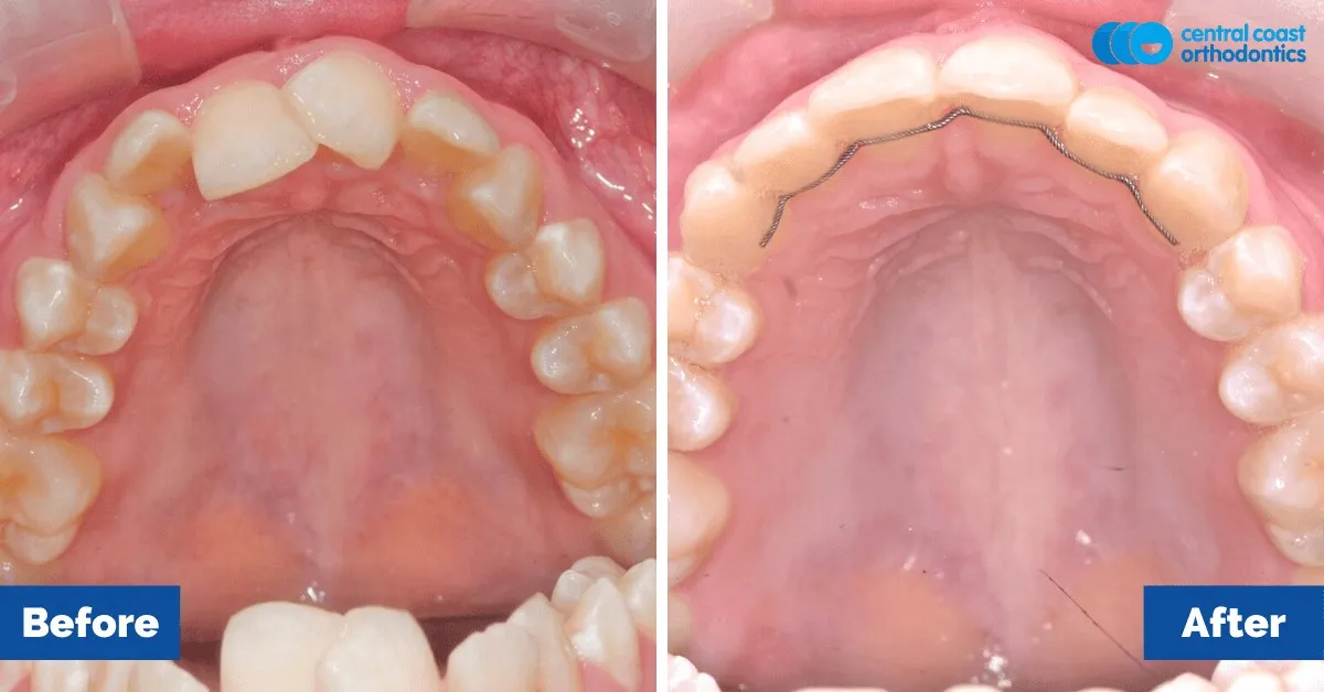 Before and after comparison, upper teeth viewed from below