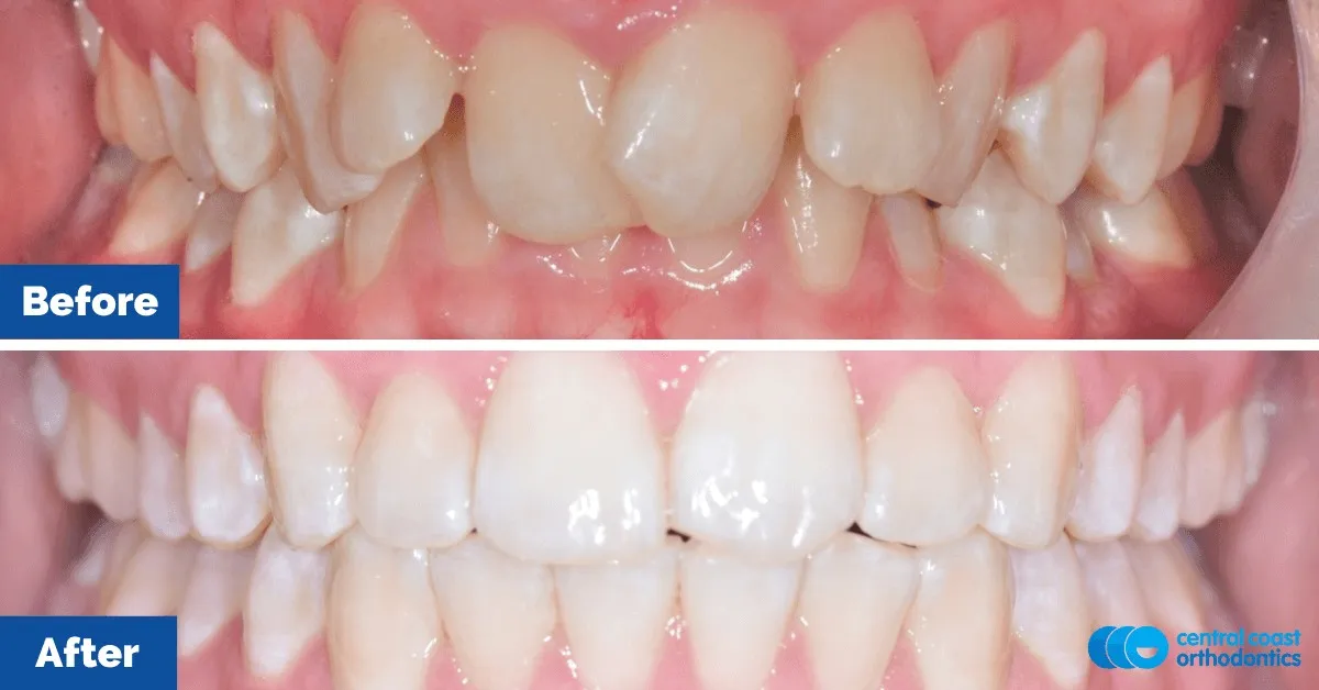 Before and after comparison, front view of the upper and lower teeth