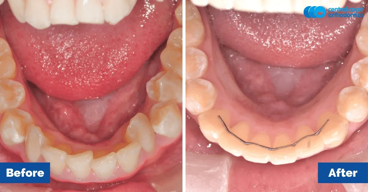 Before and after comparison, lower teeth viewed from above