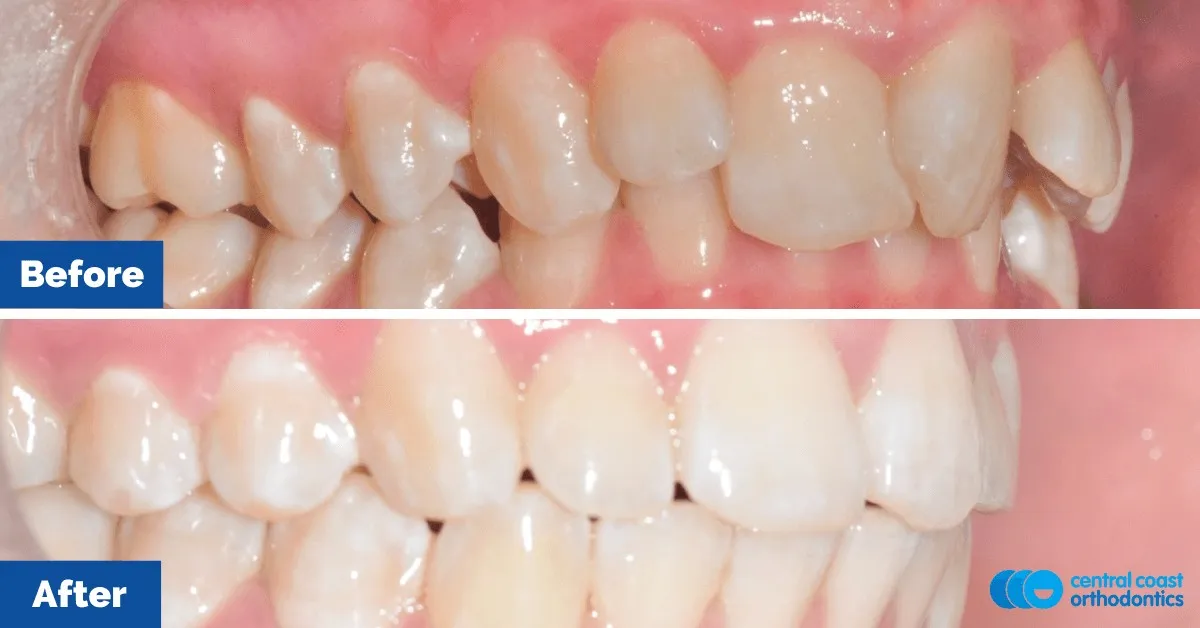 Before and after comparison, side view of the upper and lower teeth