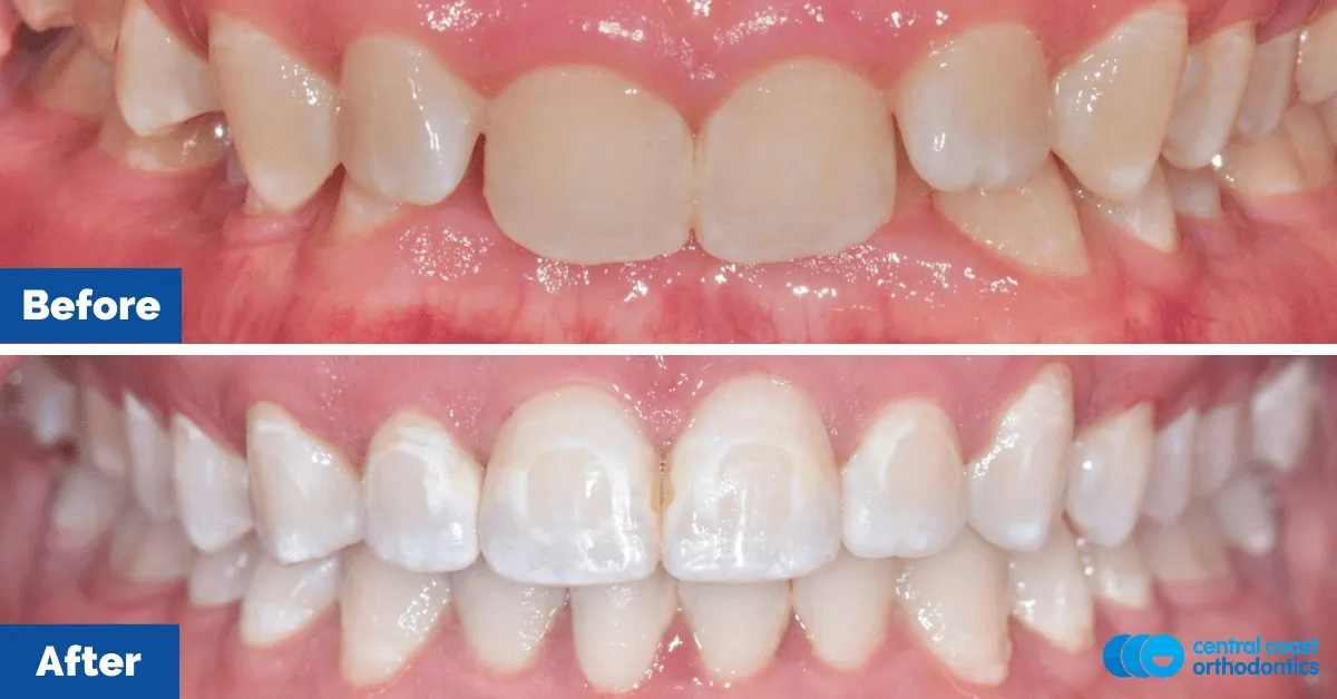 Before and after comparison, front view of the upper and lower teeth