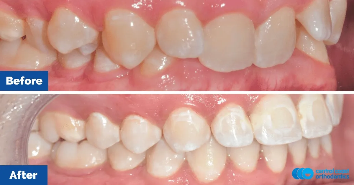 Before and after comparison, front view of the upper and lower teeth